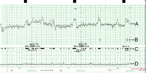 Beispiel einer typischen CTG-Aufzeichnung mit fetaler Herzfrequenzkurve und Wehenkurve.