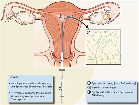 Schema der Intrauterinen Insemination (IUI)