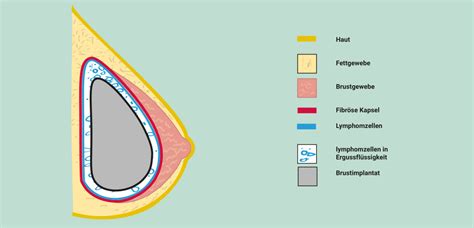 Schnittbild einer Brust zur Veranschaulichung von Brustkrebsoperationen