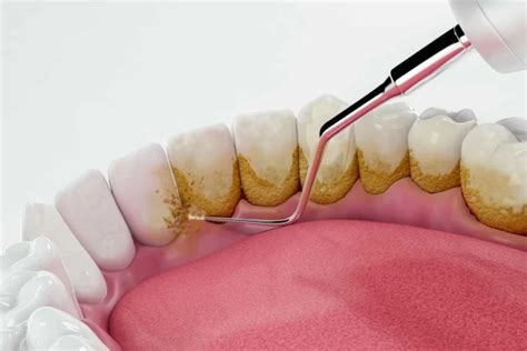 Nahaufnahme von Nuby-Löffeln, die leichte Verfärbungen durch Karottenpüree aufweisen