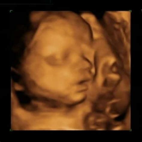 Ultraschallbild eines Babys in der 29. SSW