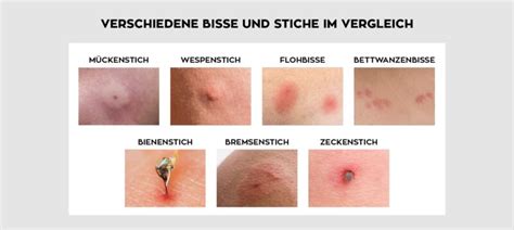 Illustration, die verschiedene Hautsymptome nach einem Insektenstich zeigt (Rötung, Schwellung, Quaddel)