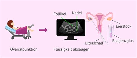 Schema des Ablaufs einer Eizellentnahme unter Narkose