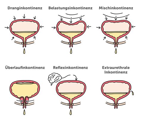 Infografik, die verschiedene Symptome einer Blasensenkung darstellt