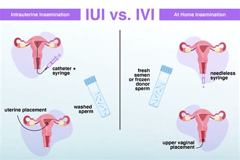 Schema der intrauterinen Insemination (IUI) mit den Schritten Follikelmonitoring, Hormonbehandlung (optional), Spermienabgabe, Aufbereitung der Spermien und Insemination.