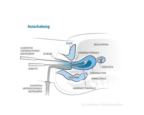 Schema einer Ausschabung (Kürettage) zur Entfernung von Schwangerschaftsgewebe.