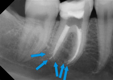 Röntgenbild eines abgestorbenen Schneidezahns mit Entzündung um die Wurzelspitze