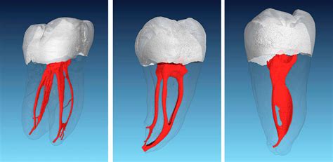 Schematische Darstellung der Wurzelkanäle bei Molaren mit ihrer Variabilität