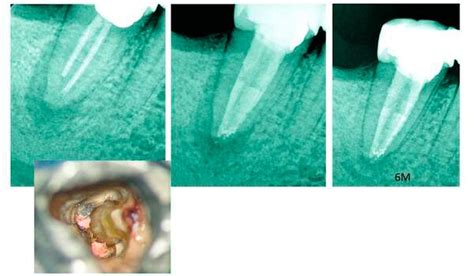 Mikroskopische Ansicht von Kanaleingängen in einem Molaren, wo fünf Kanäle gefunden wurden