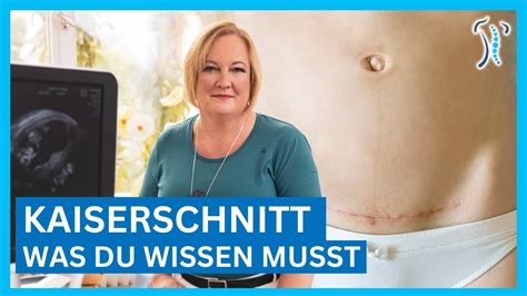 schematische Darstellung des Heilungsprozesses einer Kaiserschnittnarbe über mehrere Wochen