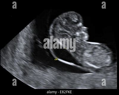 Ultraschallbild, das die Nackentransparenz eines Fötus zeigt.
