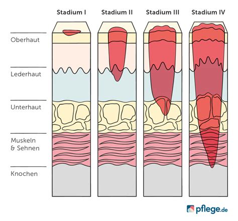 Schema: Gradeinteilung von Dammrissen