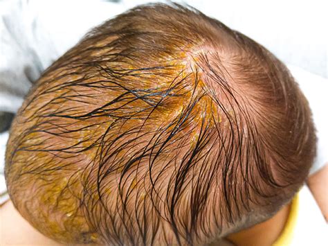 Eine Nahaufnahme von Babykopfhaut mit Kopfgneis, der mit einer weichen Bürste behandelt wird.