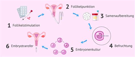 Infografik, die die Schritte der In-vitro-Fertilisation (IVF) darstellt