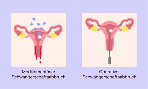 Schema der verschiedenen Methoden eines Schwangerschaftsabbruchs (medikamentös und operativ)