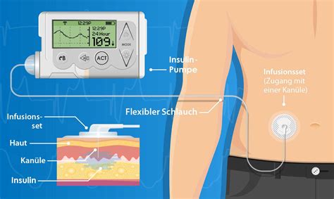 Bild einer Insulinpumpe und eines CGM-Sensors.