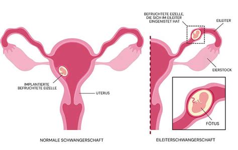 Infografik mit verschiedenen Methoden zur Risikosenkung einer Eileiterschwangerschaft.