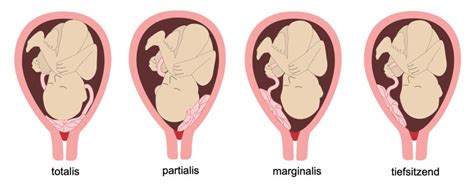 Schema, das die verschiedenen Typen der Plazenta praevia (totalis, partialis, marginalis) und eine normale Plazentalage darstellt.