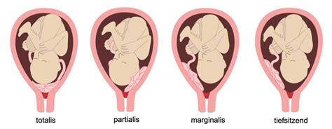 Illustration, die eine Frau mit schmerzloser vaginaler Blutung zeigt, die auf eine Plazenta praevia hindeutet.