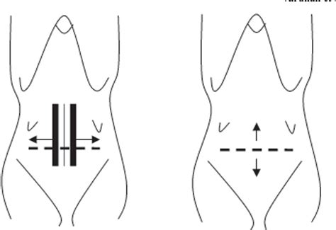 Schema der Misgav-Ladach-Methode
