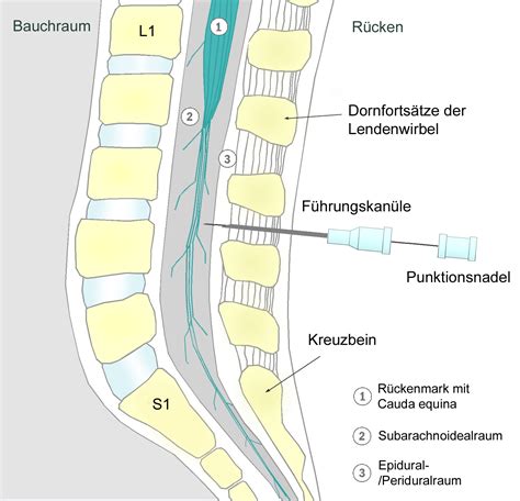 Darstellung der Spinalanästhesie