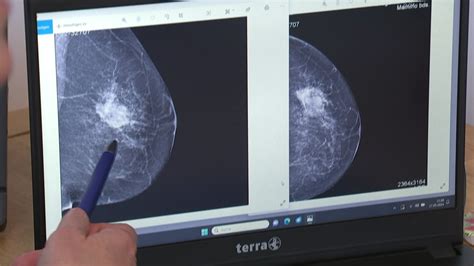 Vergleich Mammographie und Brustultraschall