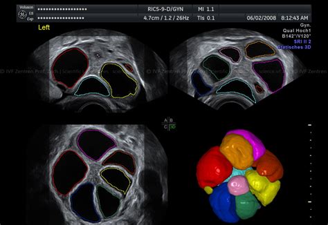 Ultraschallbild von heranwachsenden Follikeln während der Stimulation, farblich dargestellt und als 3D-Ansicht