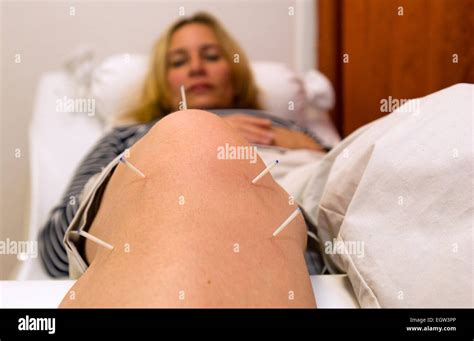 Nahaufnahme von Akupunkturnadeln oder einer schwangeren Frau, die Akupunktur erhält