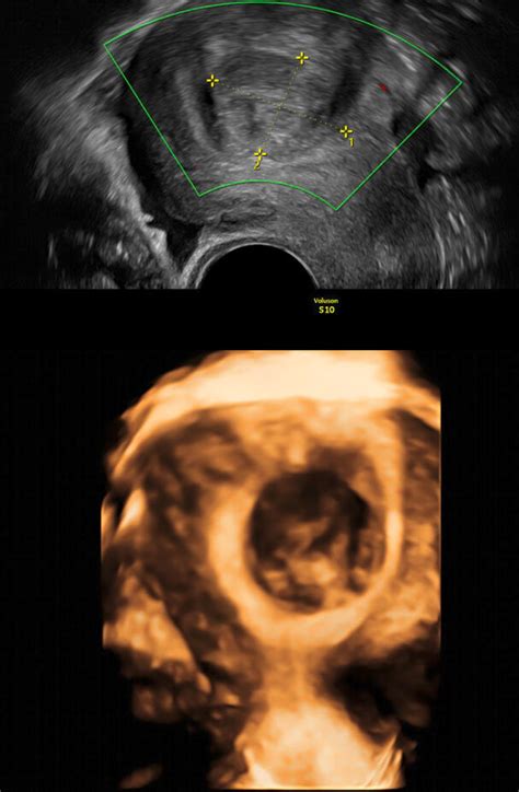 Dreidimensionaler (3D) Ultraschall zur Darstellung von Eierstockfollikeln