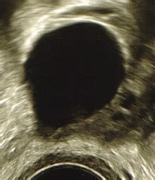 Tabelle: Follikelgröße und Schwangerschaftsrate nach Stimulation mit Clomifen