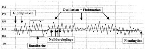 schematische Darstellung eines CTG mit Basislinie, Oszillation und Dezeleration