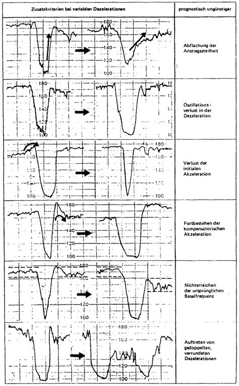 Beispiele für verschiedene CTG-Muster: Normal, mit Akzelerationen und mit pathologischen Dezelerationen