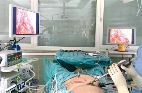 Schema einer Brustvergrößerungsoperation, die die minimalinvasive Technik hervorhebt
