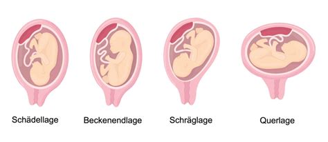 Schema der verschiedenen Kindslagen im Mutterleib