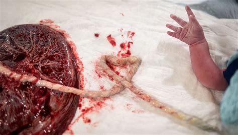 Foto der Nachgeburt mit Nabelschnur und Eihäuten