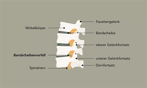 Schematische Darstellung eines Kephalhämatoms im Vergleich zu einer Geburtsgeschwulst.