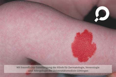 Bilder verschiedener infantiler Hämangiome im Vergleich.
