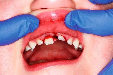 Kind mit Zahnschiene nach Zahnunfall