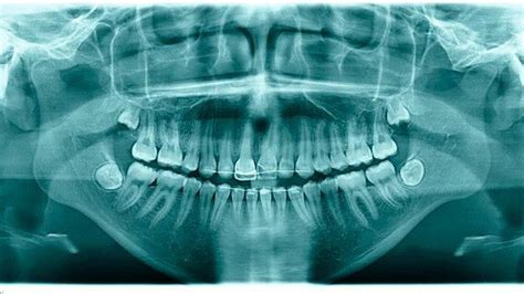 Röntgenbild eines ankylosierten Zahnes