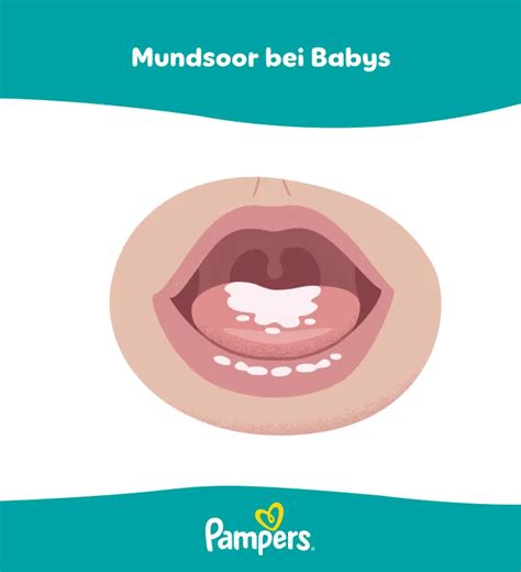 Vergleich von Mundsoor bei Babys und Brustsoor bei Müttern