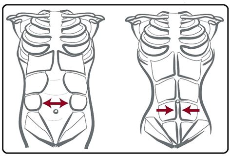 Schema der Rektusdiastase: Darstellung der geraden Bauchmuskeln und des Spaltes dazwischen.