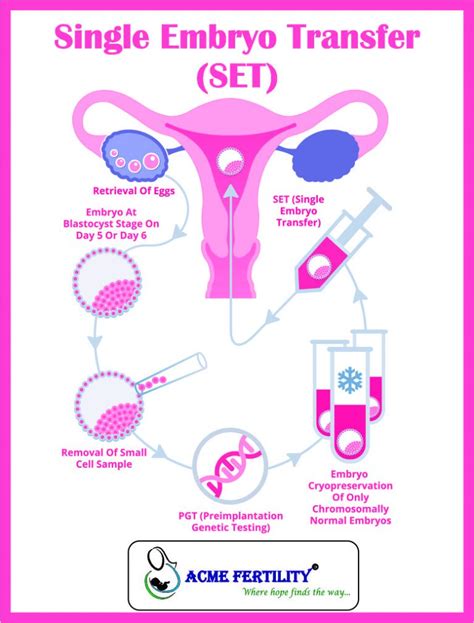 Schema zur Gegenüberstellung von Single Embryo Transfer (SET) und Double Embryo Transfer (DET) mit ihren jeweiligen Risiken und Vorteilen.