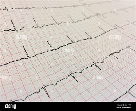Schema zur fetalen EKG-Überwachung