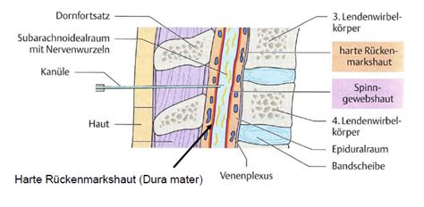 Grafische Darstellung der Spinalanästhesie