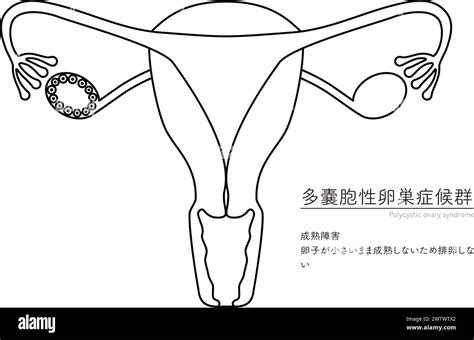 Schematische Darstellung eines künstlichen Uterus für Frühgeborene