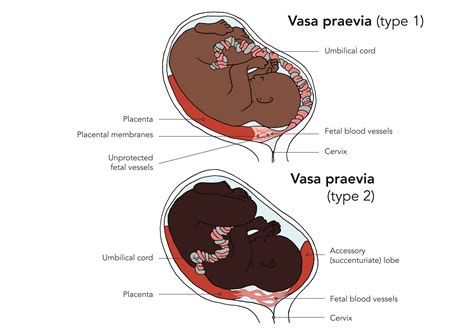 Schema, das die Lage der fetalen Blutgefäße bei Vasa Praevia im Vergleich zur normalen Nabelschnurinsertion zeigt.