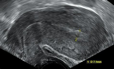 Transvaginaler Ultraschall mit Farbdoppler, der die fetalen Blutgefäße über dem inneren Muttermund bei Vasa Praevia zeigt.