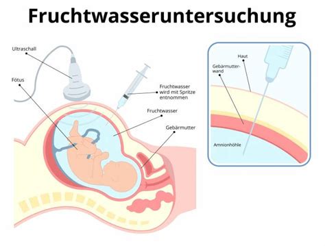 Schema der Fruchtwasserentnahme bei der Amniozentese