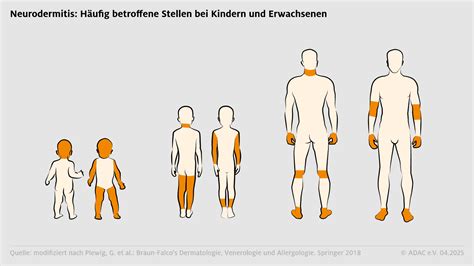 Grafik, die die Prävalenz von Neurodermitis bei Kindern in Deutschland zeigt.