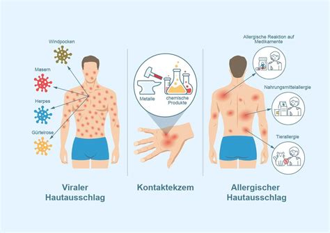 Schema, das die verschiedenen Auslöser von Hautausschlägen bei Kleinkindern darstellt (Infektionen, Allergien, Reizstoffe etc.).